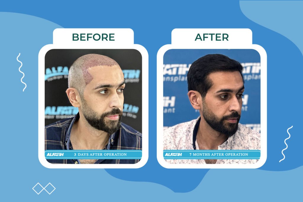 Al-Fateh clients before and after transplantation 3