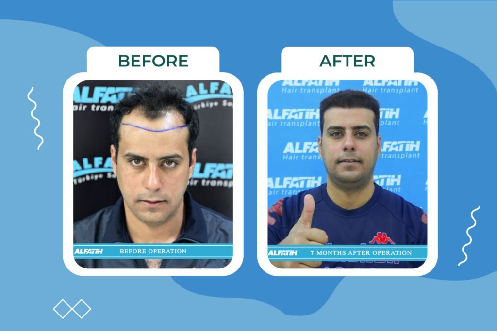 Al-Fateh clients before and after transplantation 4