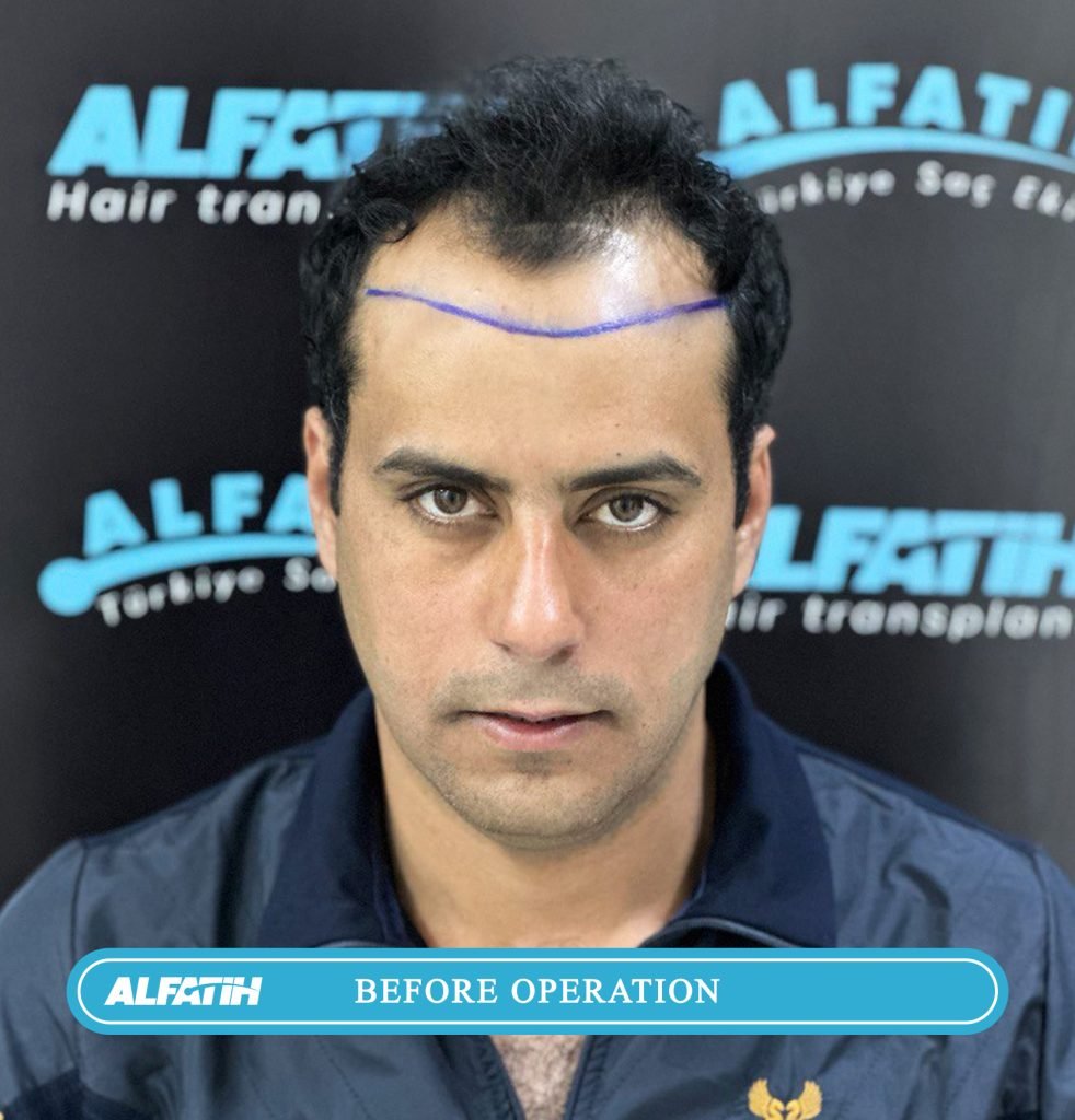 Al-Fateh clients before and after transplantation 