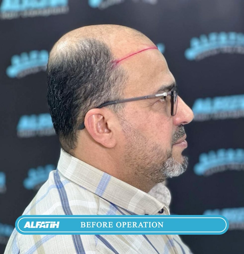 Al-Fateh clients before and after transplantation 