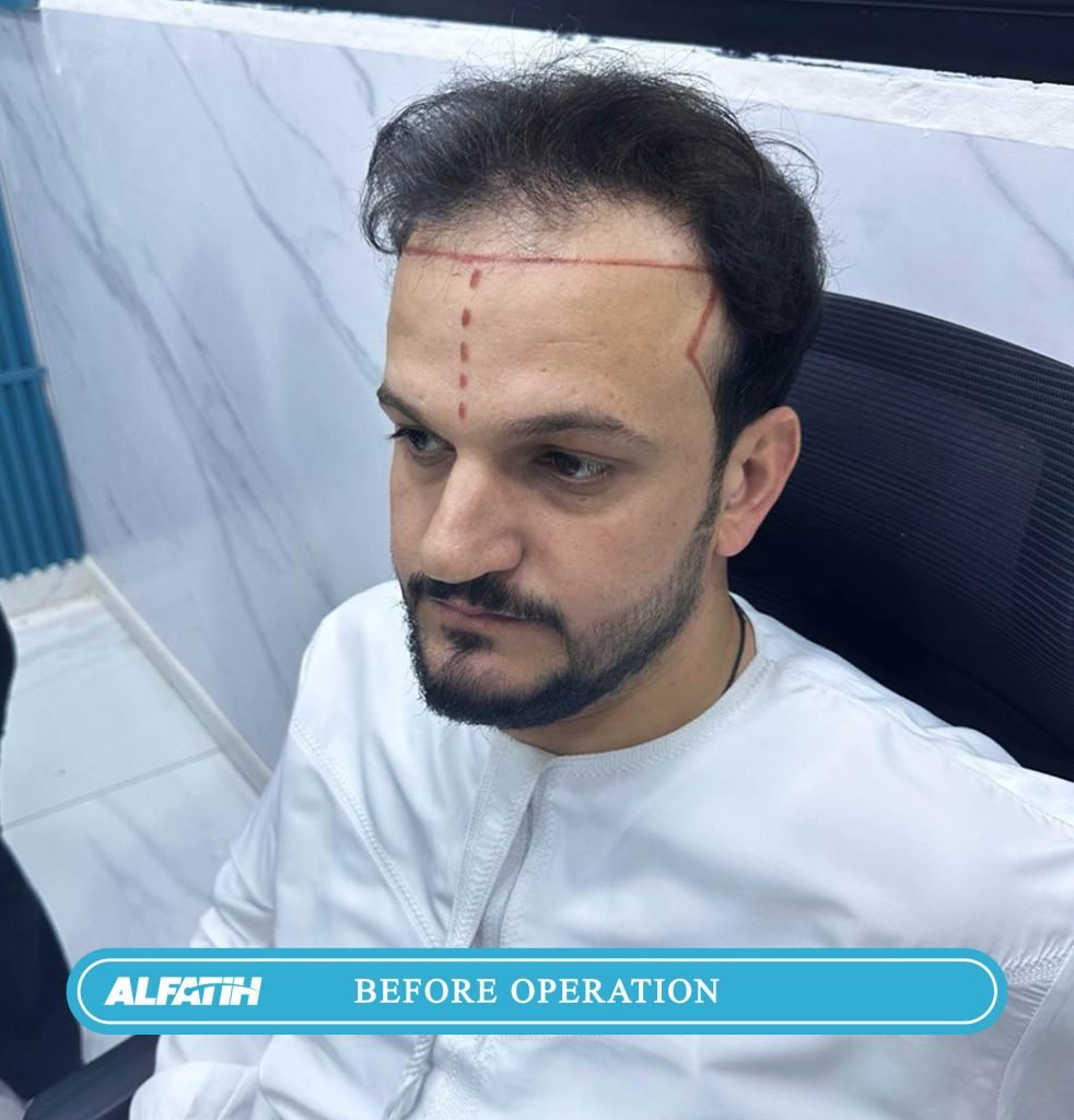 Al-Fateh clients before and after transplantation 