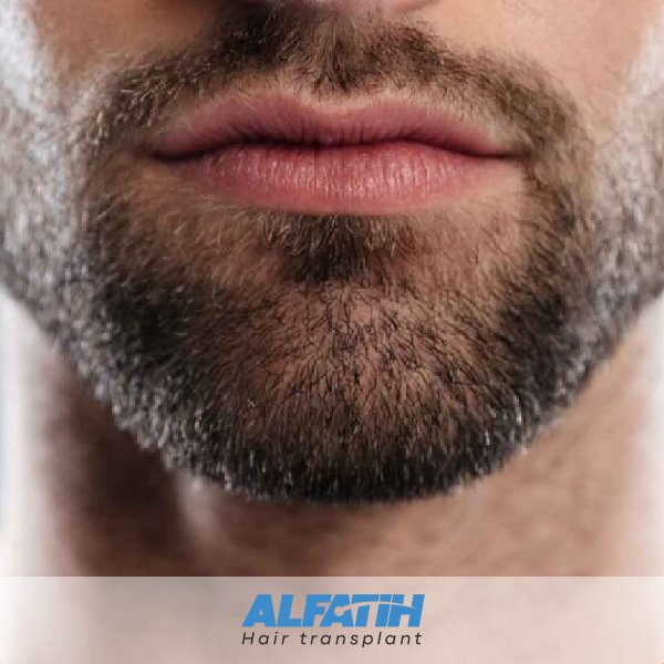 Where are the follicles taken for beard transplantation?