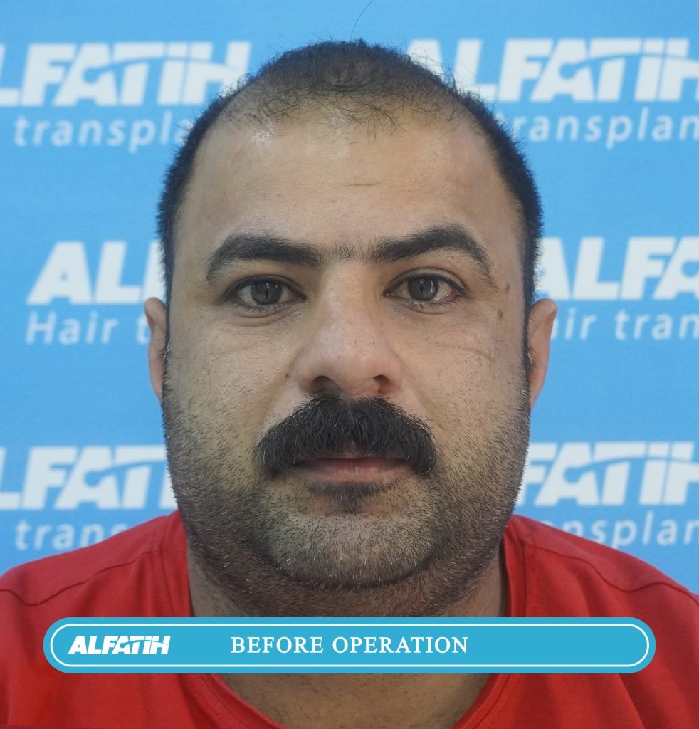 Al-Fateh clients before and after transplantation 