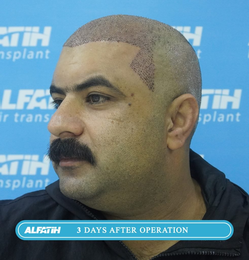 Al-Fateh clients before and after transplantation 