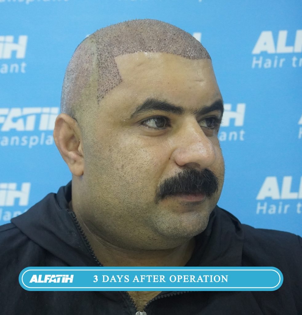 Al-Fateh clients before and after transplantation